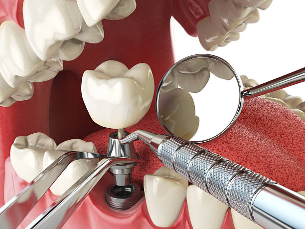 Best Root Canal Emergency Dentist  in Wtell, LA